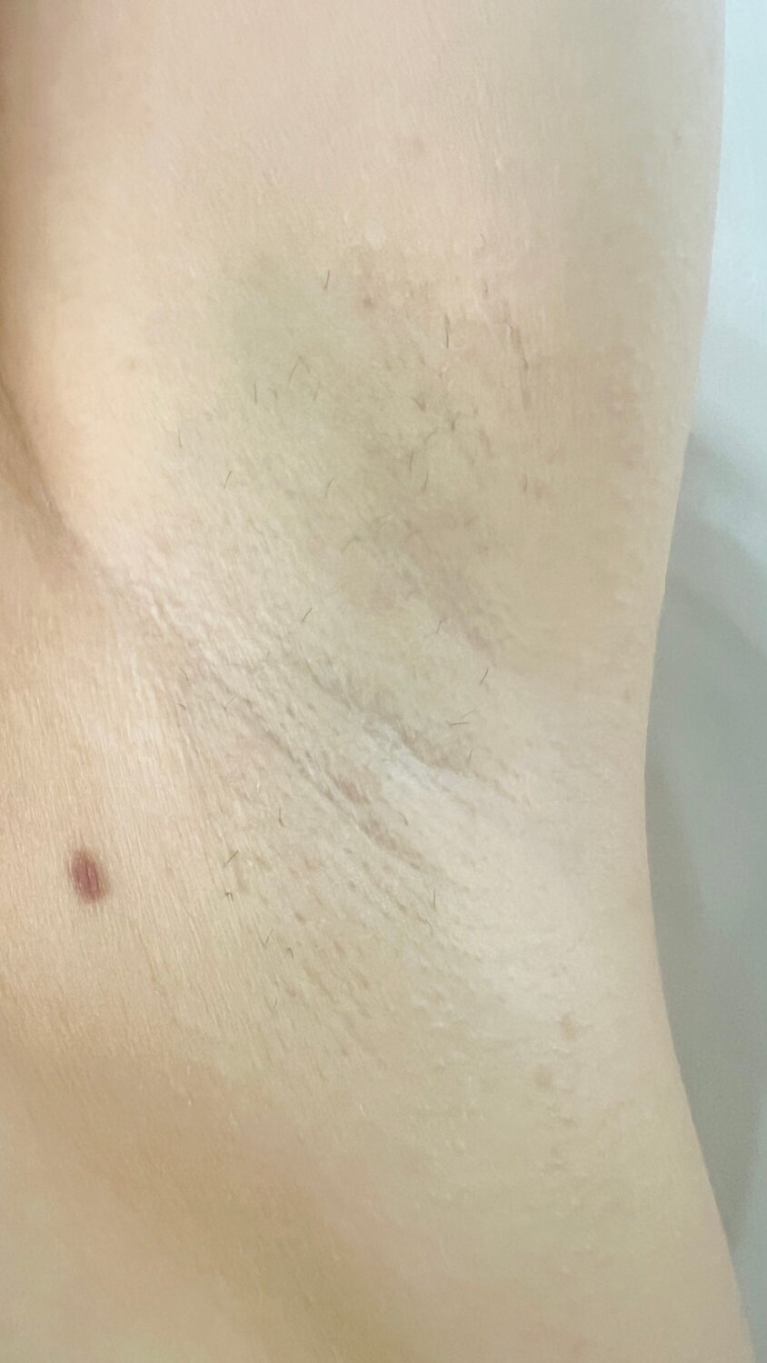 депиляция подмышек, электроэпиляция глубокого бикини, лазерная эпиляция, депиляции, лазерная эпиляция подмышек