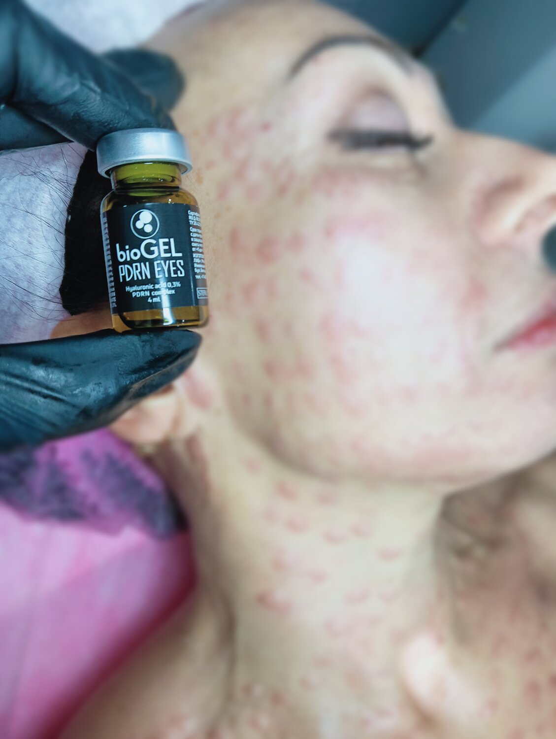биоревитализация, dermaheal биоревитализация препарат, биоревитализация препарат, препарат, биоревитализации лица