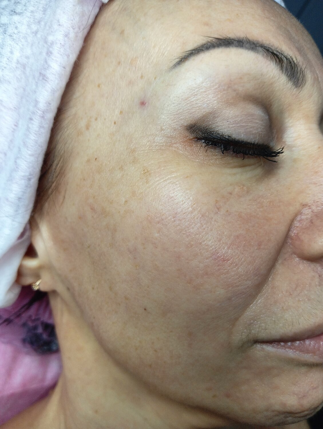 микроигольчатый rf лифтинг, эффект би би глоу, м 22 фотоомоложение, микроигольчатый rf лифтинг лица, bb glow процедура для лица