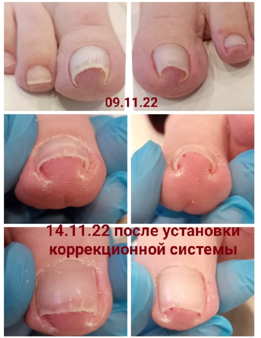 восстановление ногтевой пластины, коррекция вросшего ногтя, укрепление ногтей, врастание ногтей, обработка ногтей
