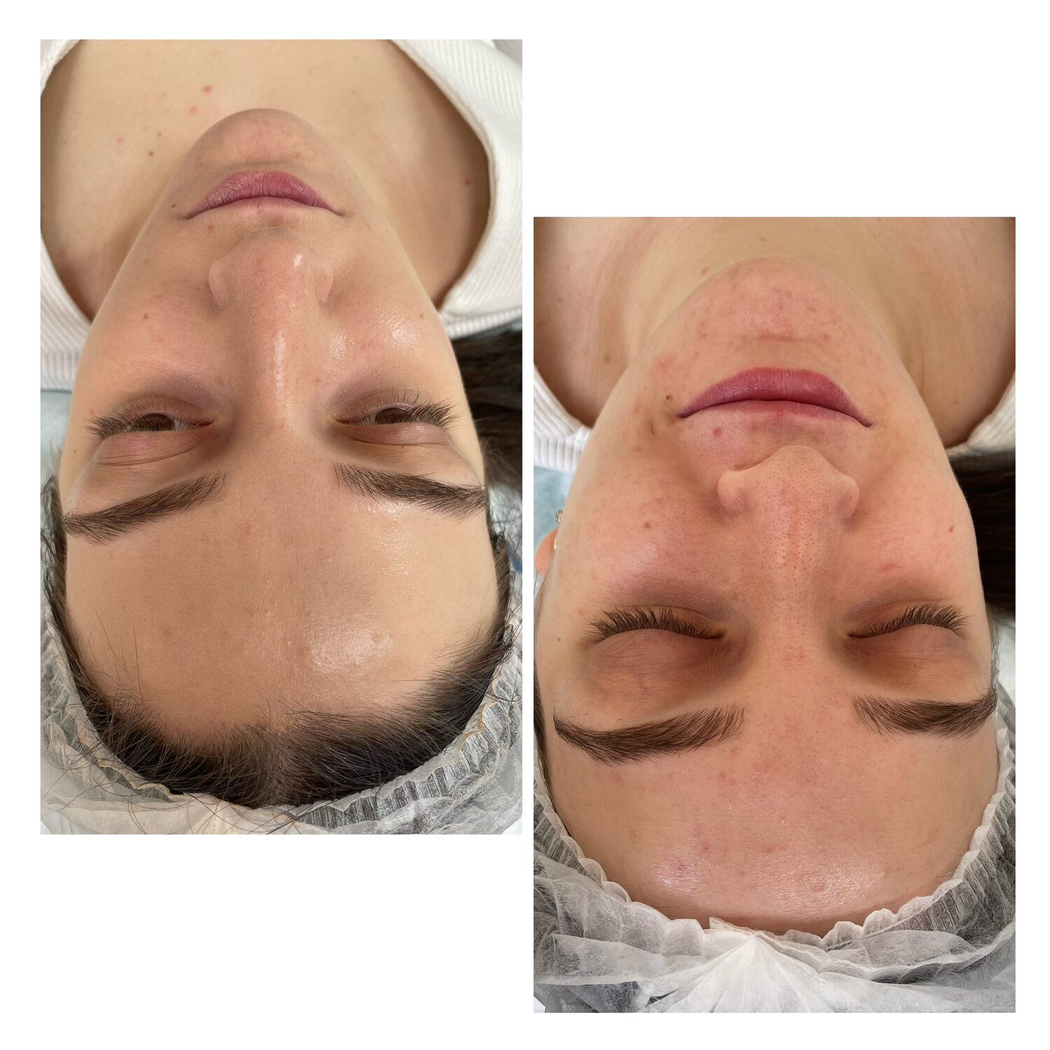 пилинг, чистка лица, карбокситерапия для лица, поверхностный пилинг, комбинированная чистка лица