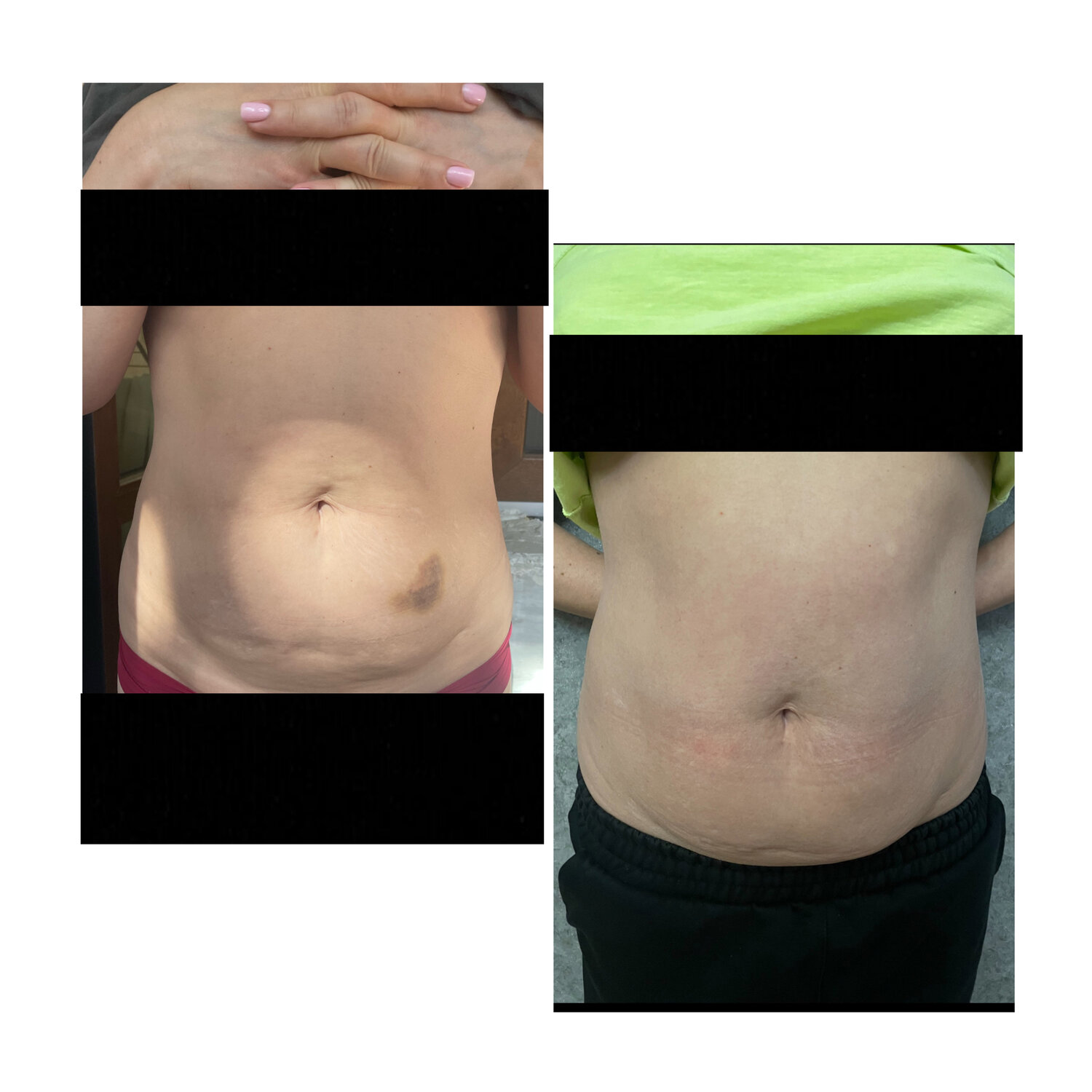 диастаз живота, после, абдоминопластика, удаление жира, живот после родов диастаз