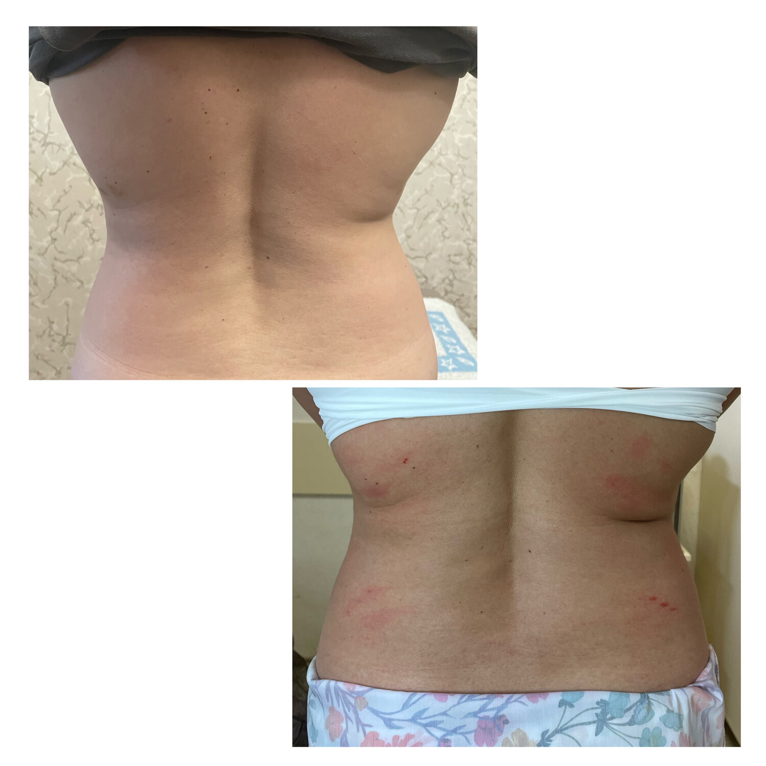 ручная липосакция, липолитики, липосакция, после, человек