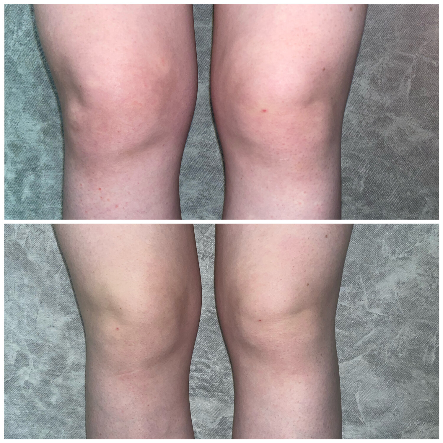 колено, следы на коже, пластика тела, убрать жир с коленей, болезнь суставов