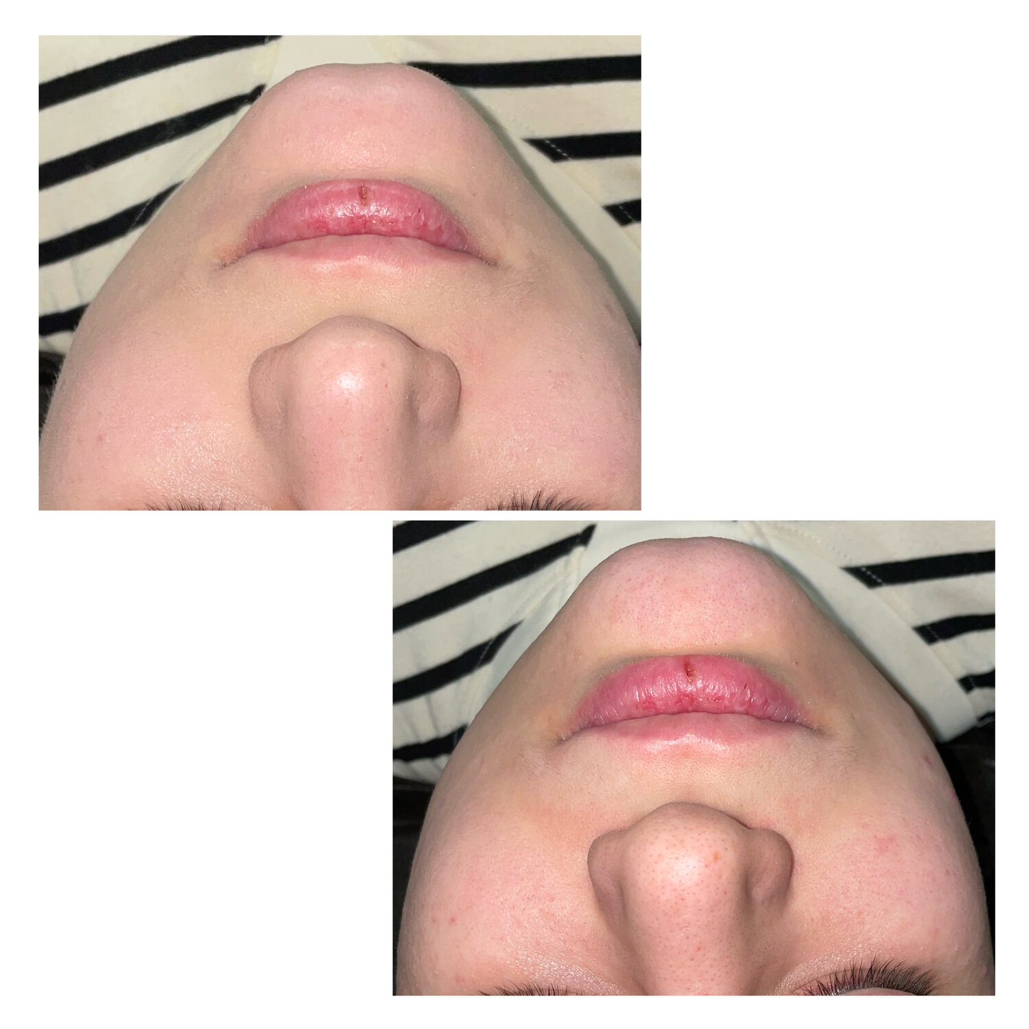 пластика губ, увеличение губ, губы, коррекция подбородка, чистка лица