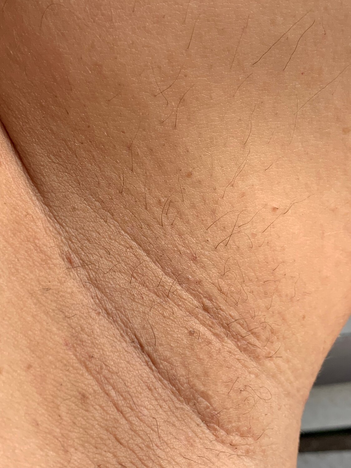 лазерная эпиляция, после лазерной эпиляции, шугаринг, эпиляция, сахарная депиляция