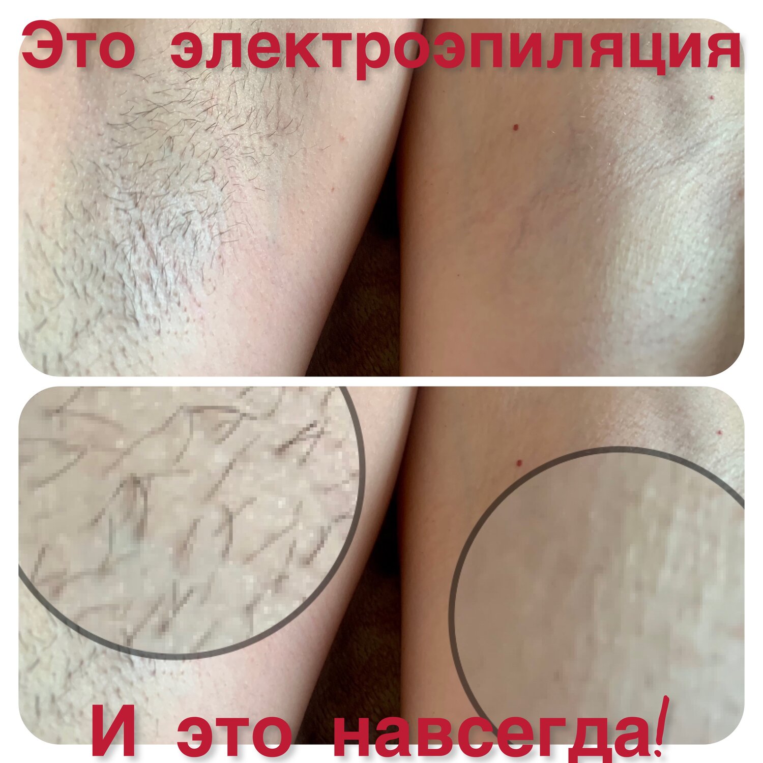 восковая депиляция, депиляция, сахарная депиляция, депиляция воском, шугаринг депиляция