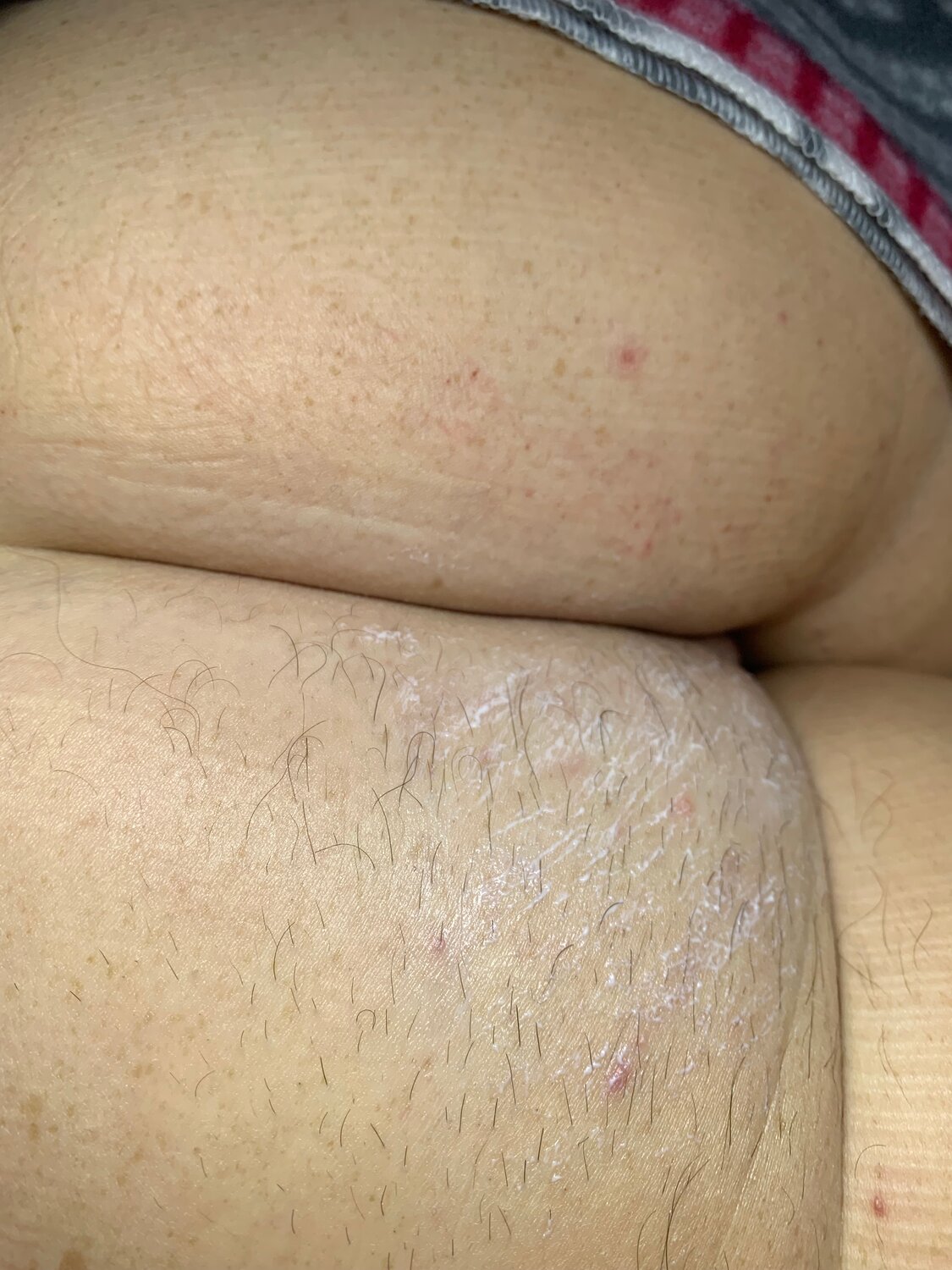 электроэпиляция, шугаринга, депиляция, сахарная депиляция, шугаринг