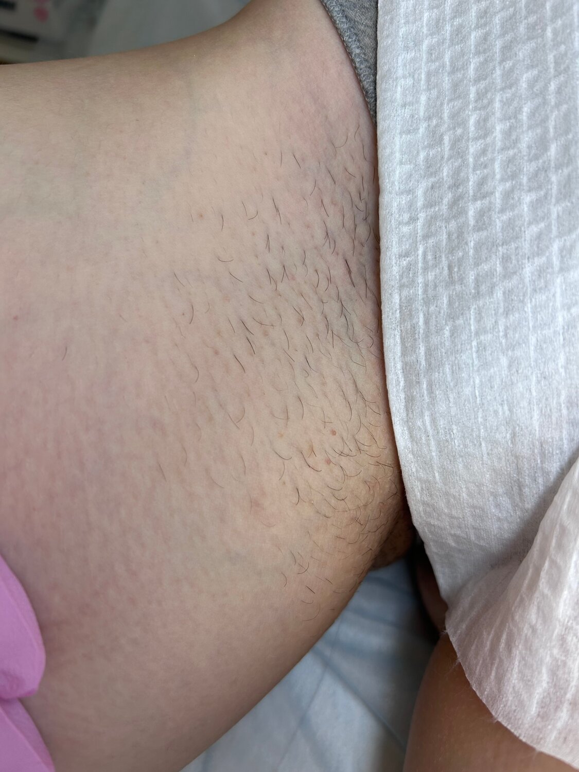 восковая депиляция бикини, восковая депиляция, депиляция, женская депиляция, шугаринг депиляция