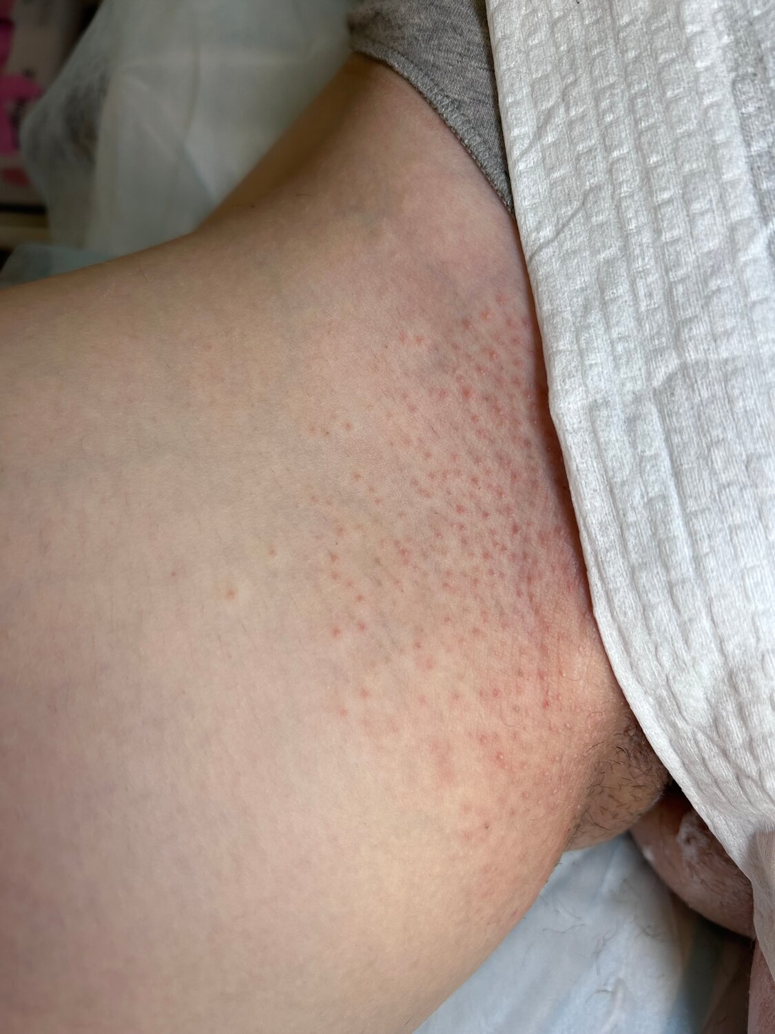 зона бикини, депиляции, глубокий бикини, сыпь, шугаринг бедра