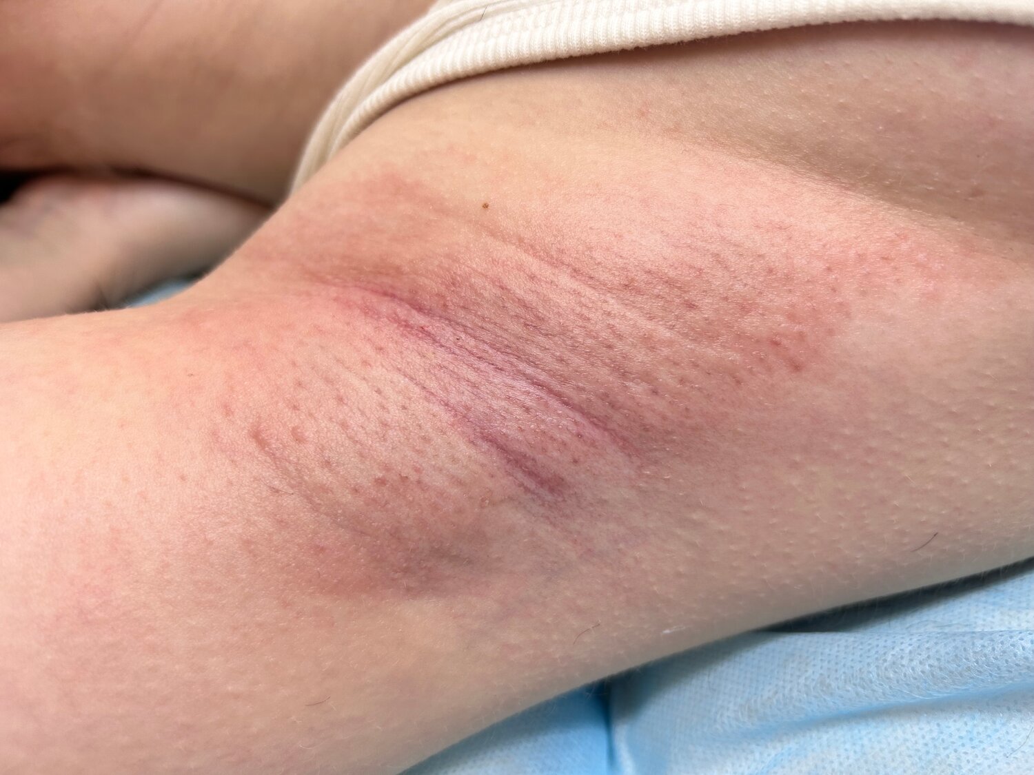 человек, шугаринга, электроэпиляция подмышек, восковая депиляция, бикини классика