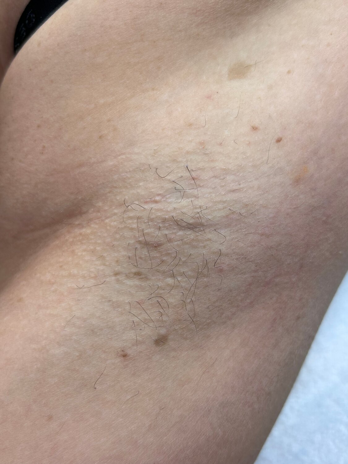 шугаринг, депиляция шугаринг, восковая депиляция, шугаринга, эпиляция