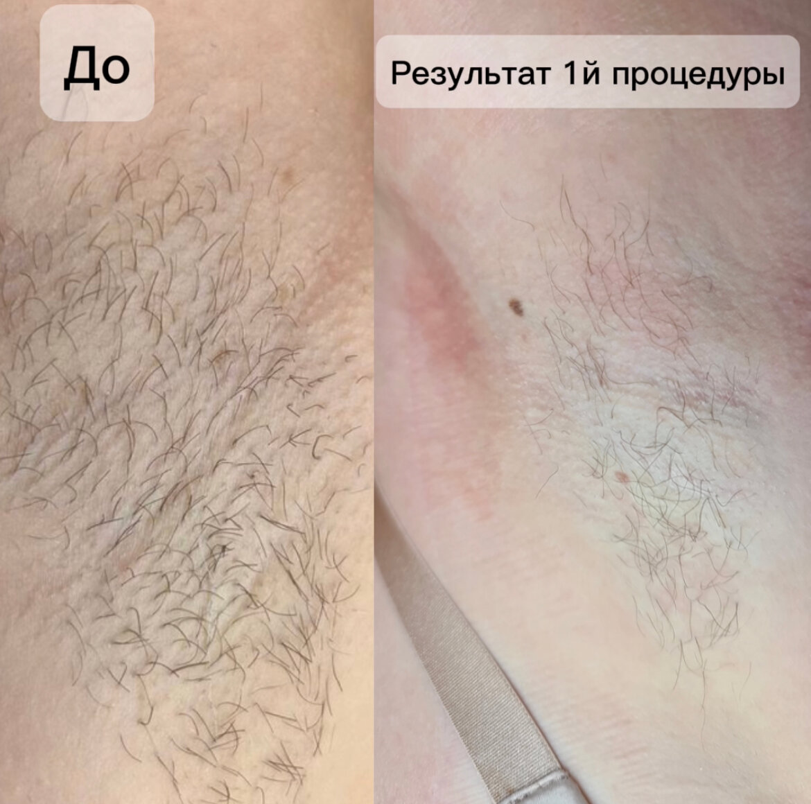 электроэпиляция, восковая депиляция, электроэпиляция подмышек, эпиляция, электроэпиляция бикини