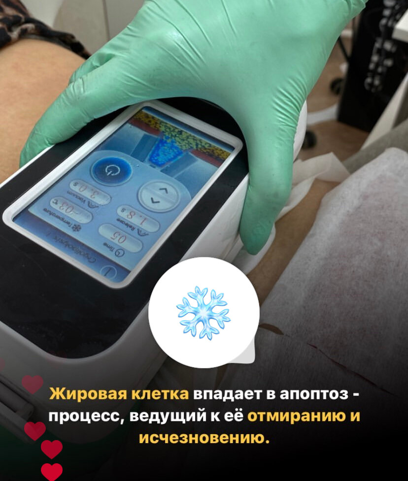аппарат, криолиполиз аппарат, аппарат криолиполиза, процедура, физиотерапия аппараты
