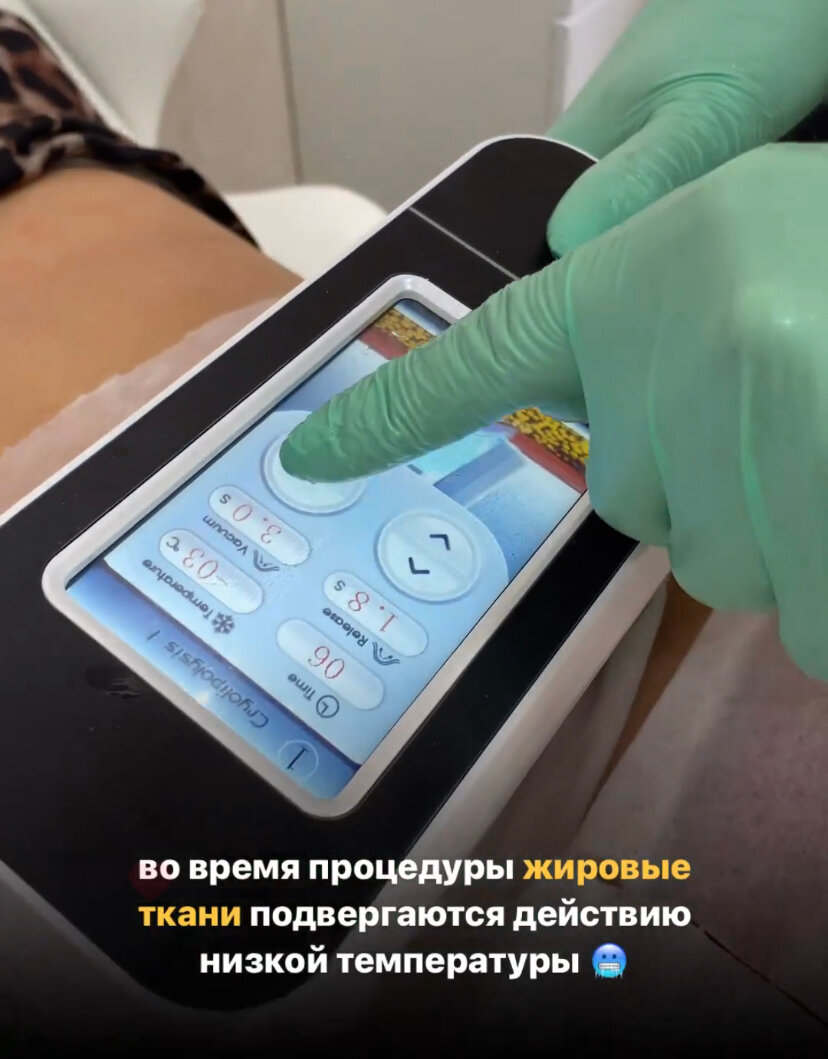 процедура, криолиполиз аппарат, криолиполиз, часть тела, аппарат для похудения
