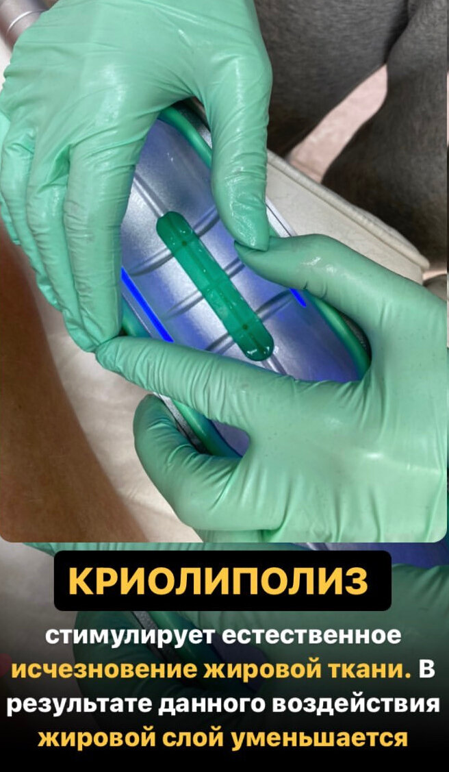 подкожно жировой слой, криолиполиз, жировые отложения, мезотерапия тела, липолитики