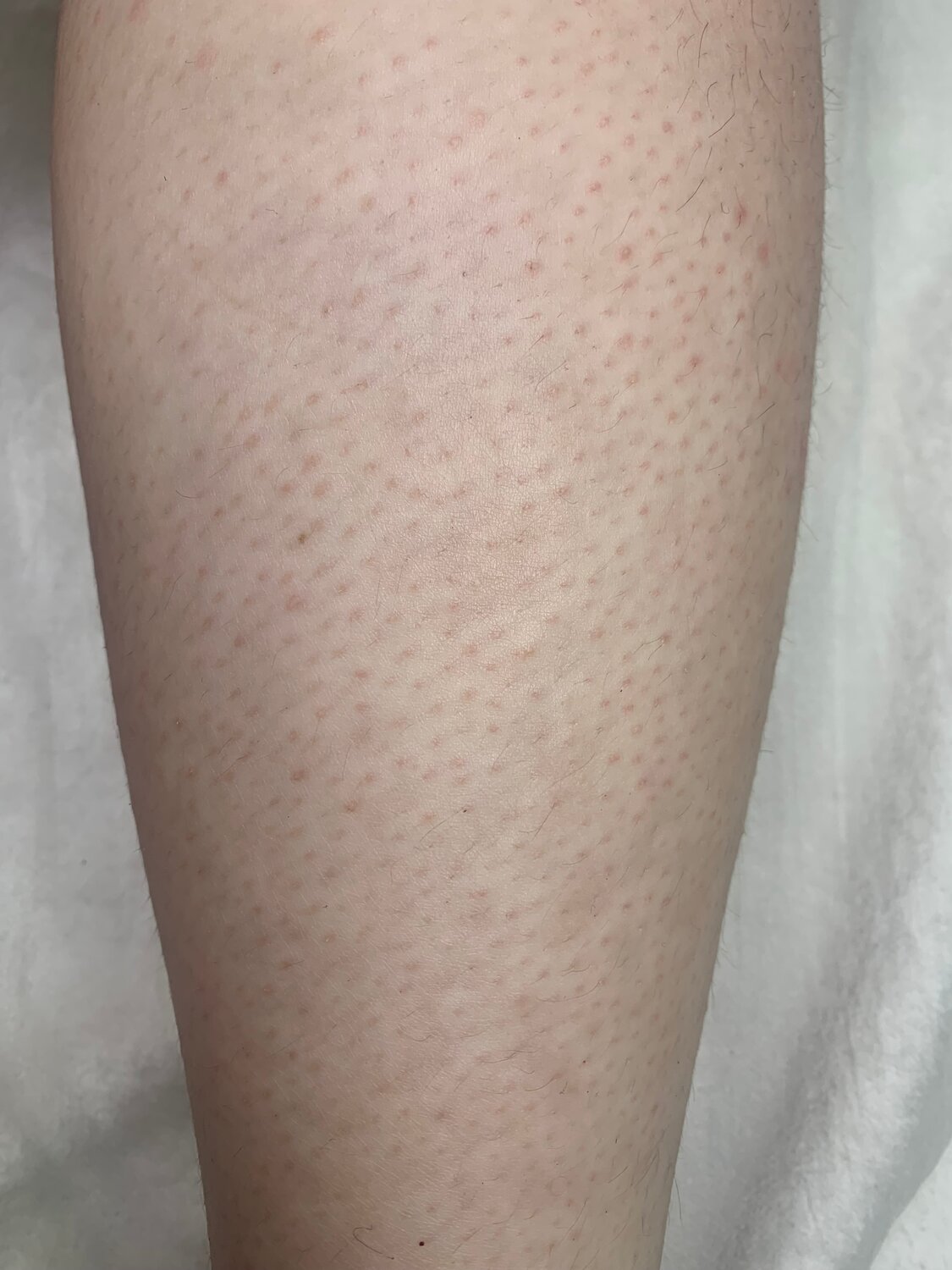 красные точки на ногах, раздражение на ногах, восковая депиляция, пятна на ногах, депиляция