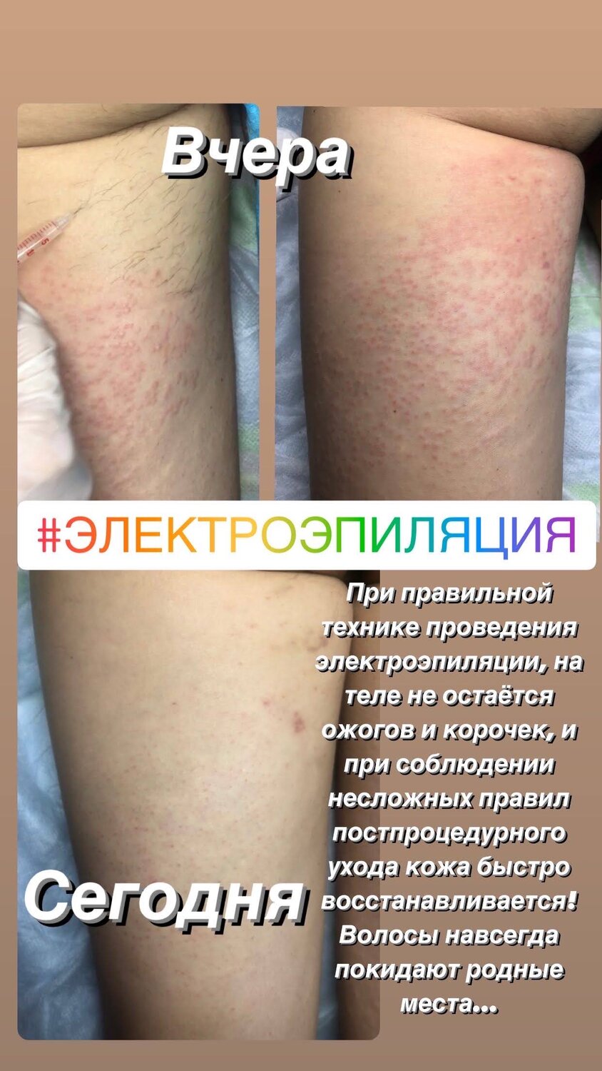 электроэпиляция бленд метод, электроэпиляция, электроэпиляция сразу после, лазерная эпиляция или электроэпиляция, электроэпиляция в москве