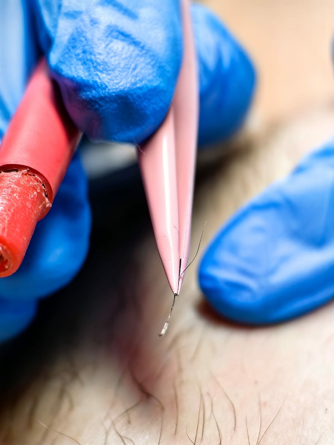 электроэпиляция, электроэпиляция в москве, следы на коже, шугаринга, аппарат для электроэпиляции