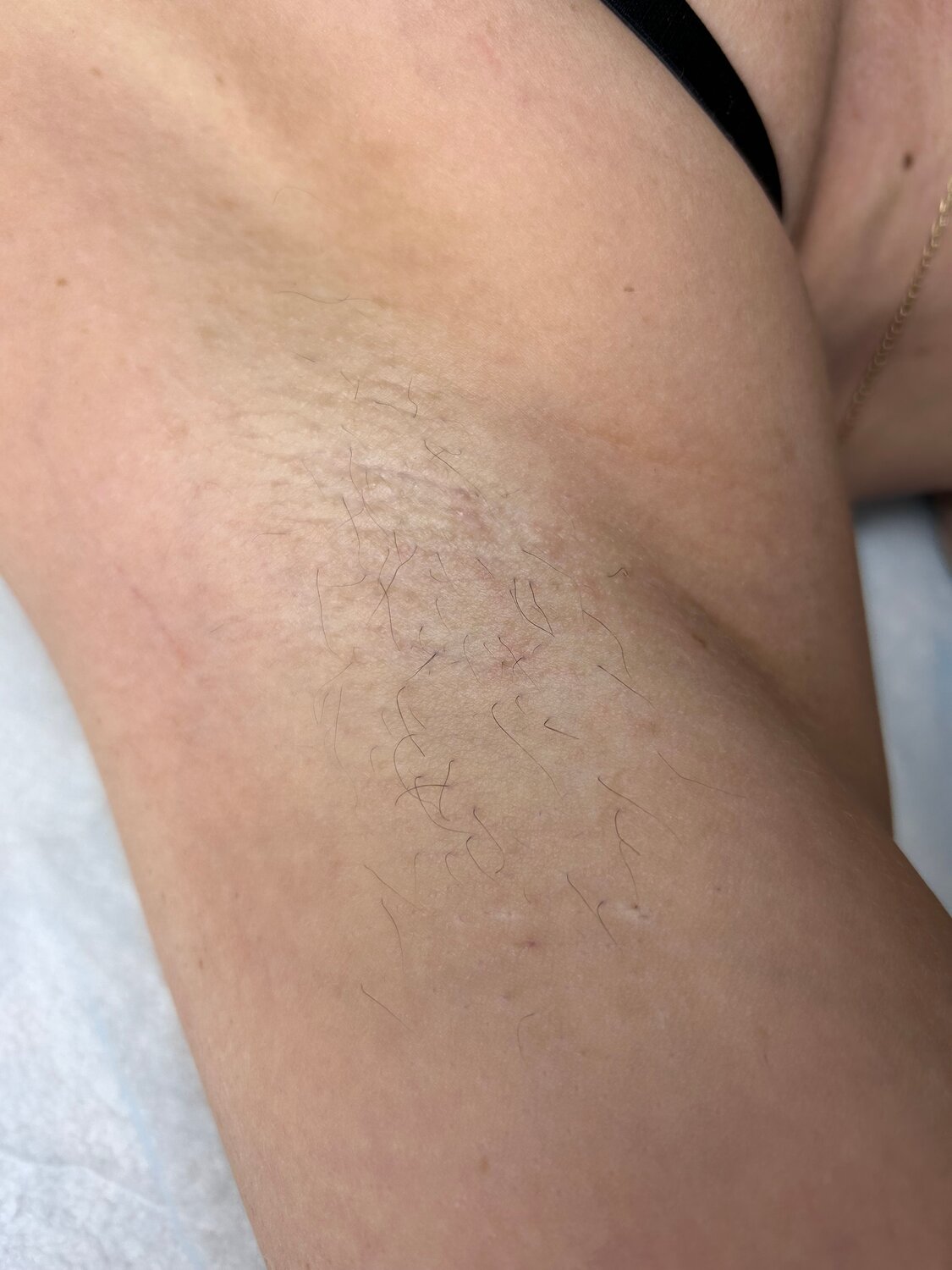 восковая депиляция, депиляция, электроэпиляция, эпиляция, шугаринг