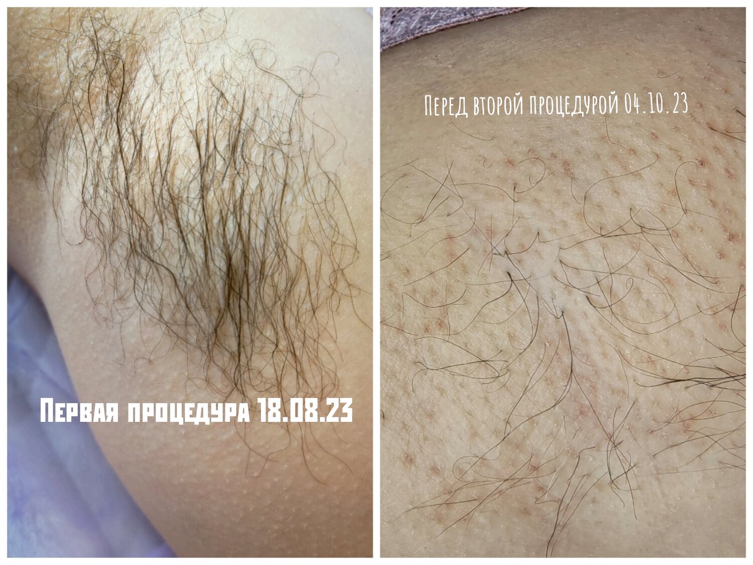 электроэпиляция, восковая депиляция, электроэпиляция глубокого бикини, что такое электроэпиляция волос, депиляция воском