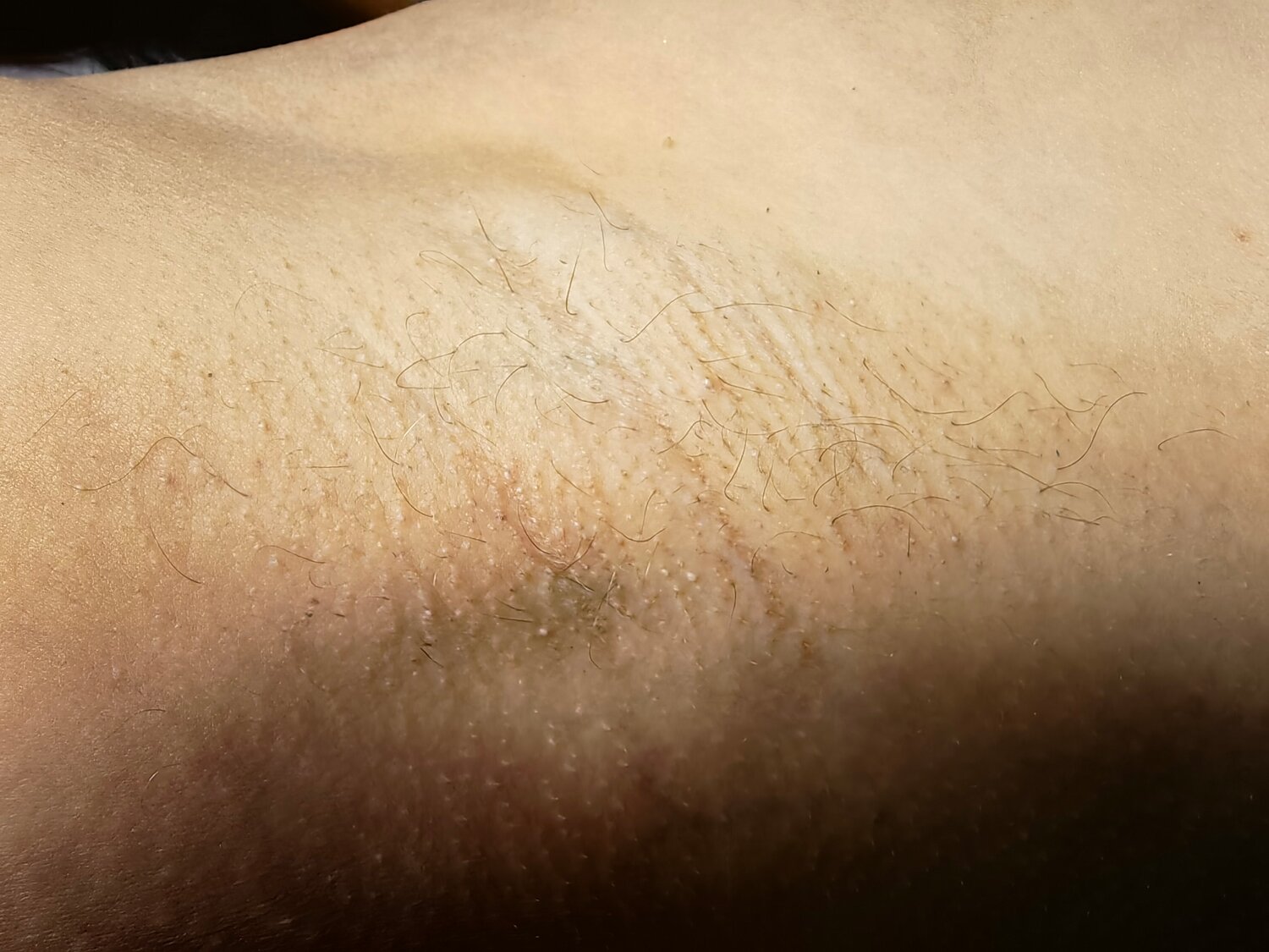 восковая эпиляция, эпиляция воском, восковая депиляция, шугаринг рук, шугаринга