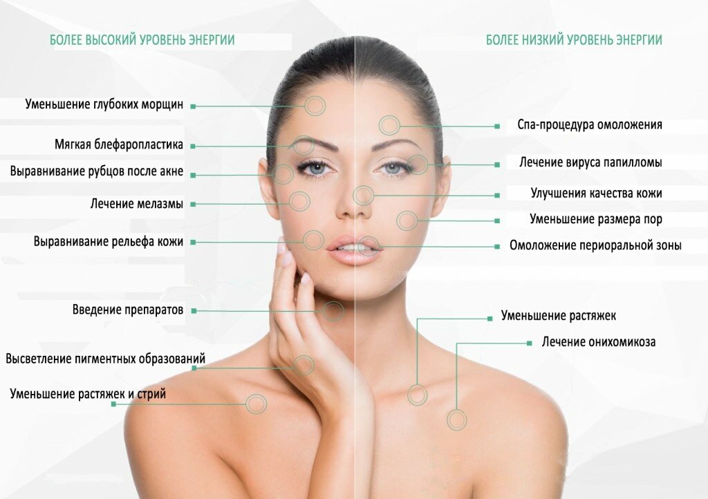 плазменная регенерация кожи neogen, идеальная кожа, схема лица зоны для ювидерма, омоложение лица, лицо