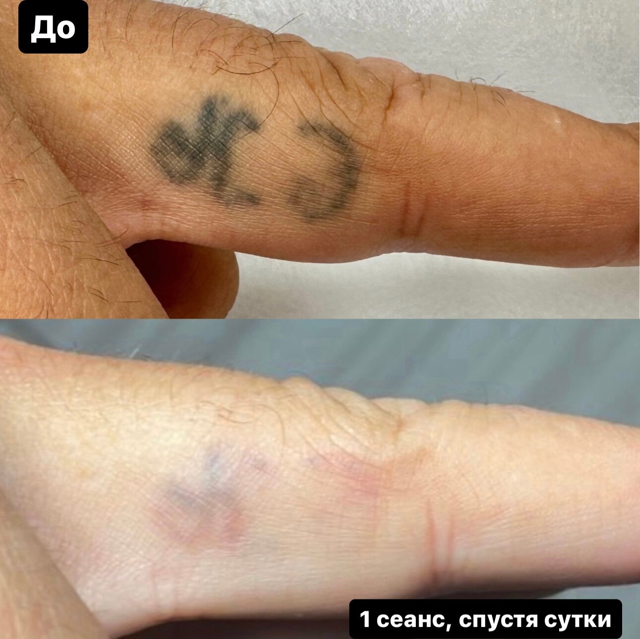 удаление татуировок лазером, выведение тату лазером, удаление тату лазером, после удаления тату лазером, удаление татуировок